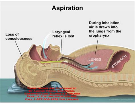 aspiration definition medical procedure