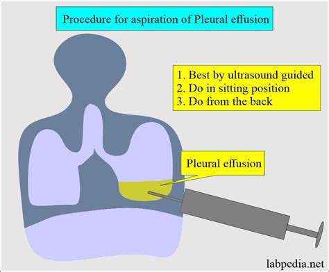 aspiration of fluid cpt