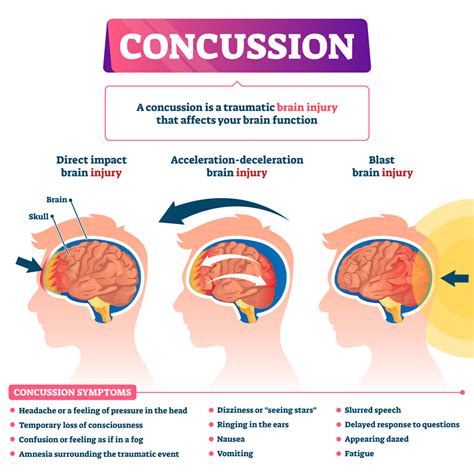 Assessing the Risks of Concussions
