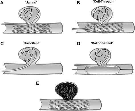 Assisted Coil Embolization Technique