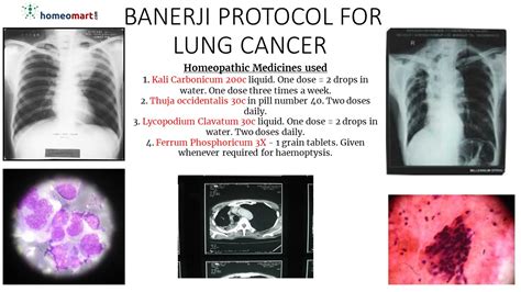 Asthma Banerji Protocol