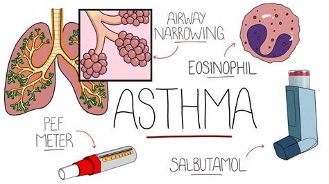Asthma Explained Youtube