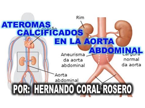 ateromatosis de aorta abdominal