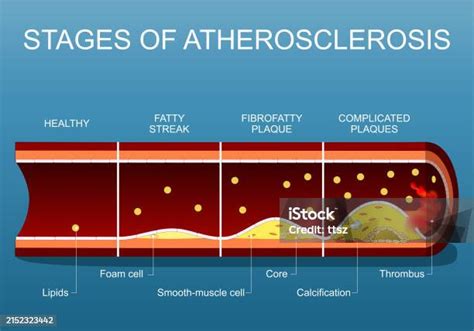 Aterosklerosis