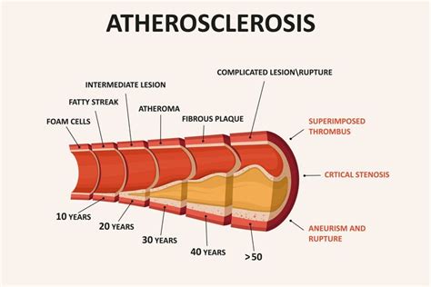 Arteriosklerosis Gejala, penyebab dan mengobati Alodokter