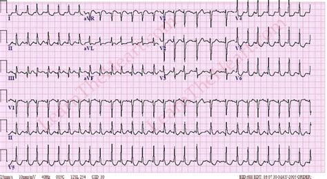 Atrial Fibrillation with Rapid Ventricular Rate (Example 3