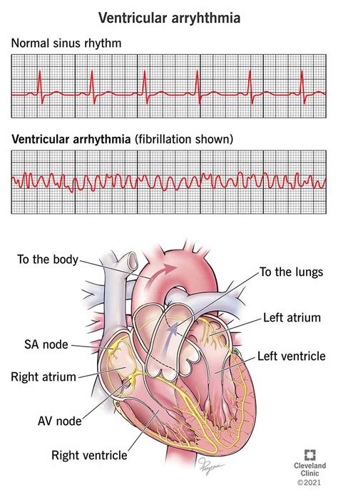 atrial and ventricular arrhythmias