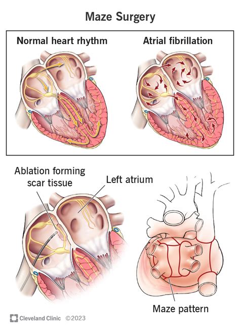 Effective Atrial Fibrillation Surgery: Restoring Heart Rhythm Naturally