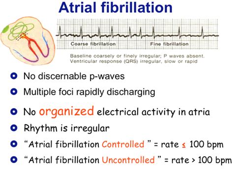 atrial flutter meaning in urdu