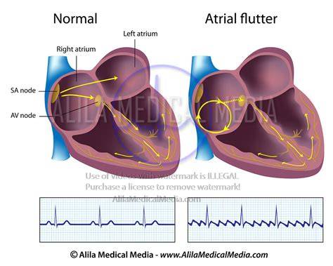 Atrial flutter classification, causes, ECG diagnosis & management