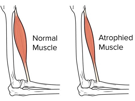 atrophy medical definition and symptoms