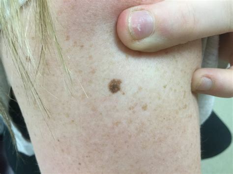 atypical mole cancer