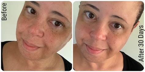 View 22 Augustinus Bader Before And After foescesz