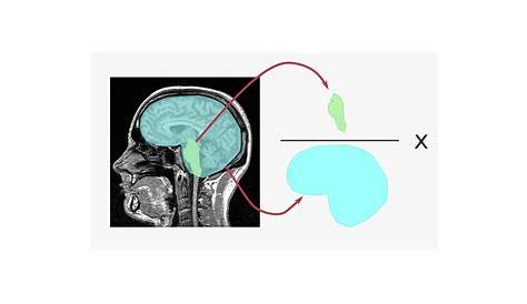 Esclerodiario empp - emsp: Los cambios en el volumen cerebral pueden