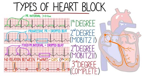 Av Block Of Heart