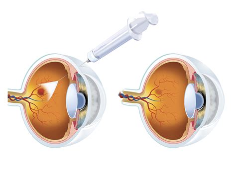 avastin eye injection diabetic retinopathy