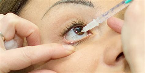 avastin eye injection procedure