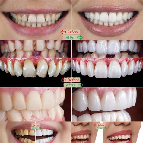 average cost of veneers