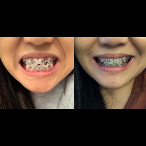 Average Weight Loss With Braces