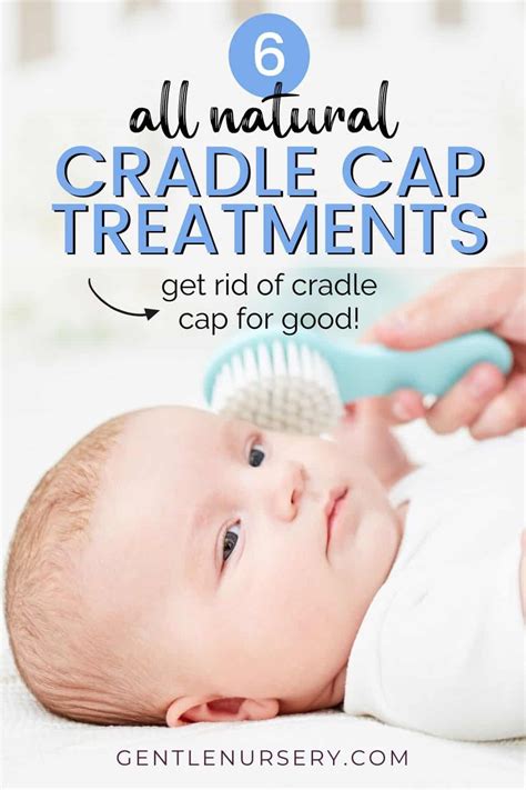 wmcheck.info:ayurvedic treatment for cradle cap in babies