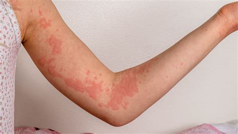 azulfidine allergies caused