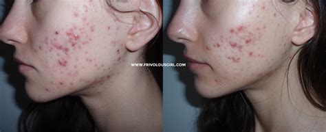 B5 Side Effects For Acne