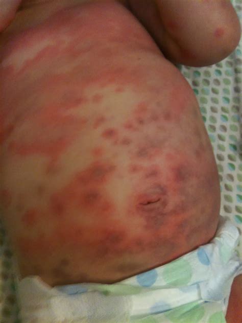 Allergic erythema multiforme reaction to amoxicillin in children and
