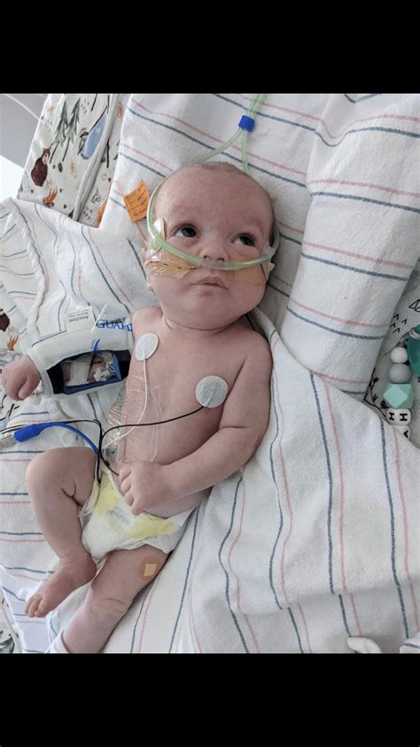 baby born with esophagus not connected