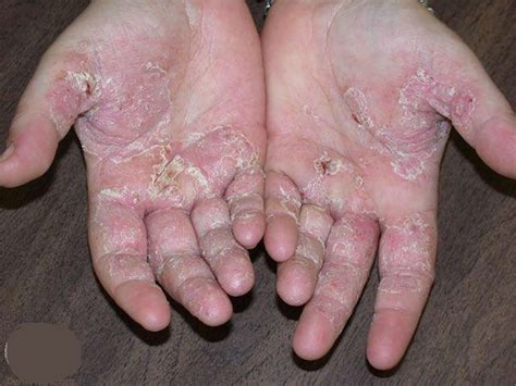baby eczema on hands