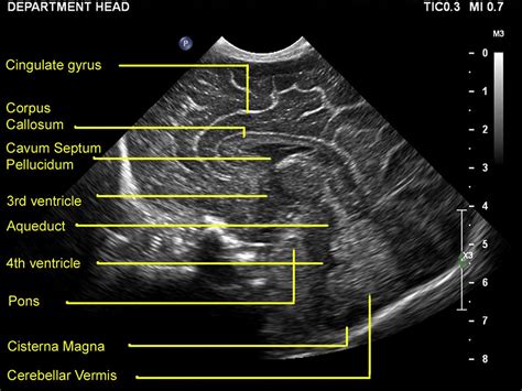 baby head anatomy ultrasound