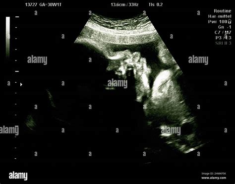 baby head on ultrasound
