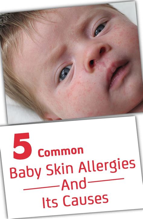 vyazma.info:baby skin allergy medicine