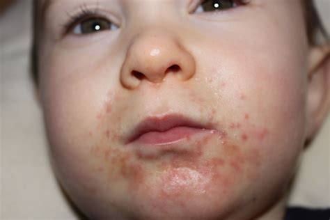 Baby Skin Rash 6 Months