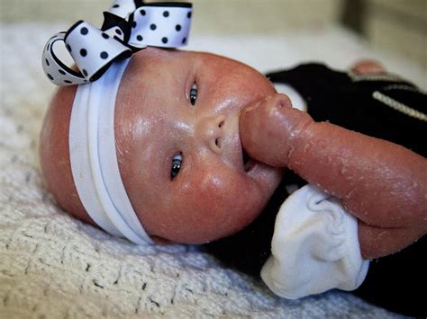 baby with harlequin ichthyosis