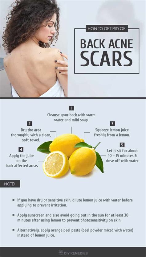 Top 20 DIY Home Remedies for Back Acne Scars Search Home Remedy