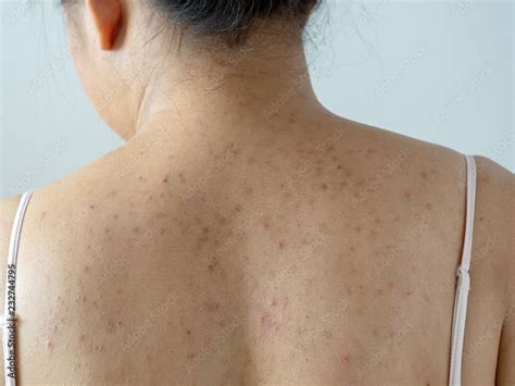 Back Acne Dark Spots