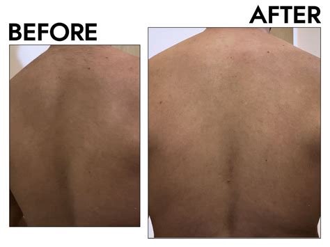 back scrub treatment