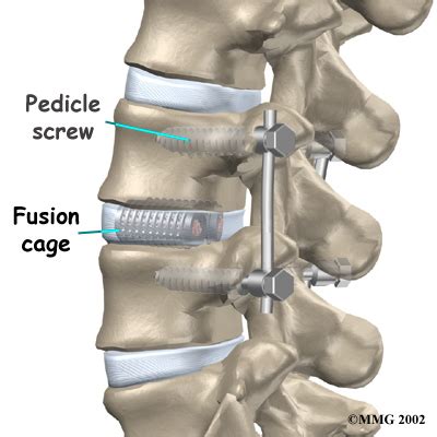 Understanding Back Surgery Fusion: Is It the Right Treatment for Your Spine?