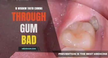 back tooth coming through gum