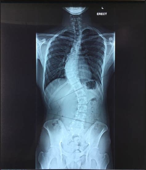 What Your Back X Ray Results Might Reveal About Your Spine Health
