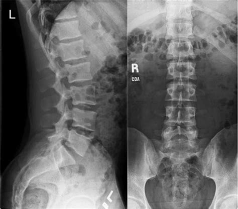Back X Ray Radiation