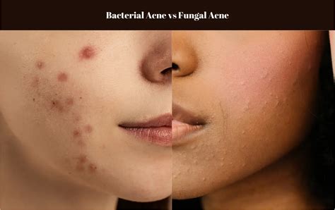Bacterial Acne vs Fungal Acne: Understanding the Differences and How to Treat Them