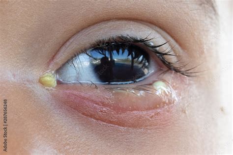 bacterial conjunctivitis in child