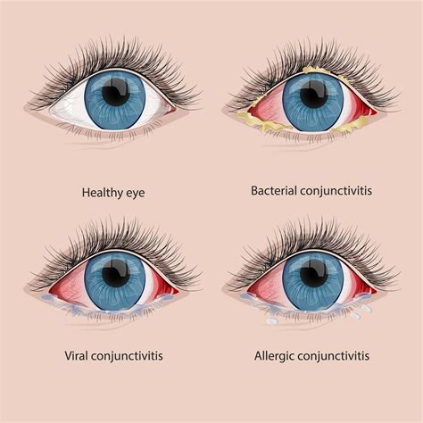 bacterial conjunctivitis sore throat
