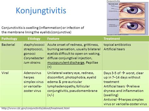 bacterial conjunctivitis treatment in child
