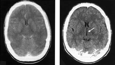 bacterial meningitis ct scan