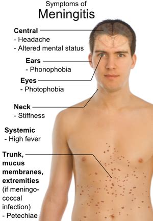 bacterial meningitis symptoms in men