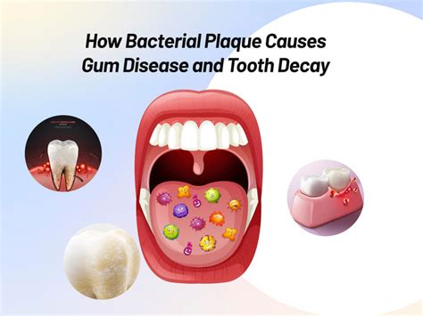 Bacterial Plaque How To Reduce