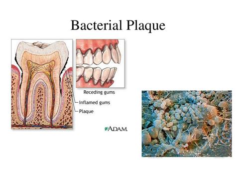 Bacterial Plaque Synonym