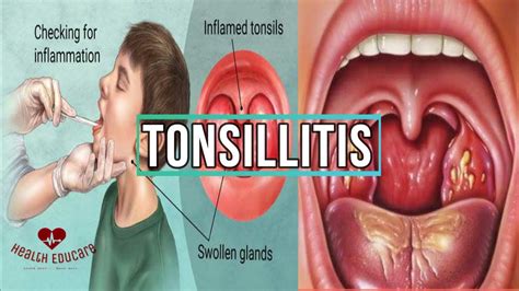 bacterial tonsillitis symptoms